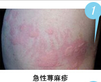 急性荨麻疹