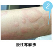 慢性荨麻疹