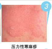 压力性荨麻疹