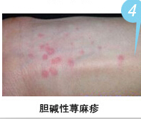 胆碱性荨麻疹