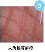 人为性荨麻疹