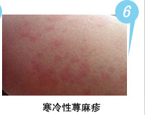 寒冷性荨麻疹
