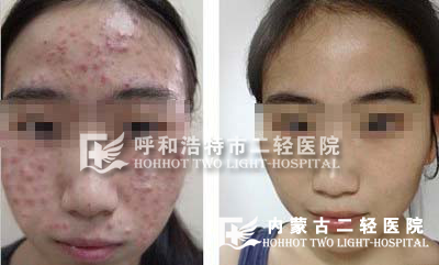 青春痘康复案例