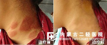 皮炎康复案例