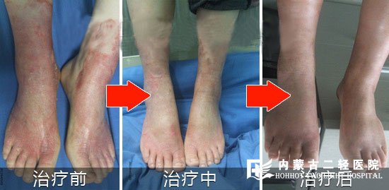 湿疹康复案例