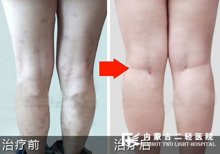 荨麻疹康复案例