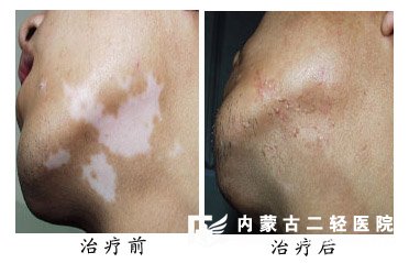 白癜风康复案例