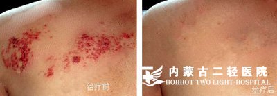带状疱疹康复案例