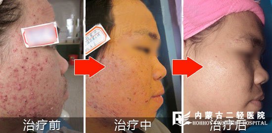 痤疮康复案例