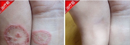 体癣康复案例