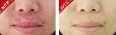 毛囊炎康复案例
