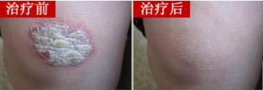 银屑病康复案例