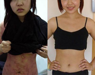 和林格尔县黄女士银屑病康复案例