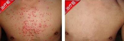 包头市林先生皮肤过敏康复案例