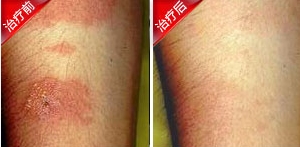 鄂尔多斯市马先生皮肤过敏康复案例
