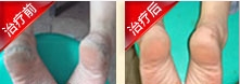 包头市61岁袁大妈手足癣康复案例