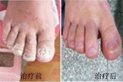 鄂尔多斯市18岁佳佳足癣康复案例