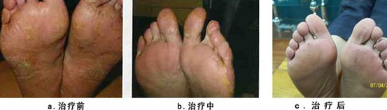 赤峰市35岁傅先生足癣康复案例