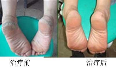 土默特左旗45岁张朝碧手足癣康复案例