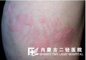 皮肤红肿痒是怎么回事