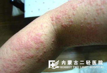皮肤红肿痒是怎么回事