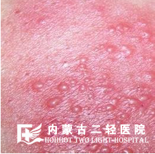皮肤红肿痒是怎么回事