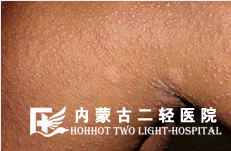 皮肤结痂是怎么回事