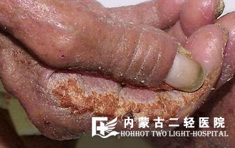皮肤结痂是怎么回事