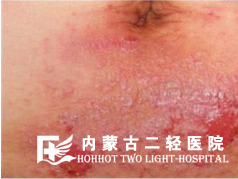 皮肤糜烂水肿是怎么回事