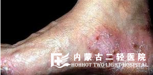 皮肤增厚是怎么回事