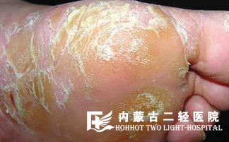 皮肤增厚是怎么回事