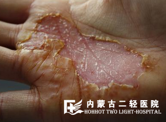 皮肤增厚是怎么回事