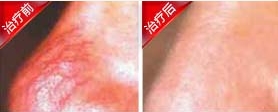 天津酒糟鼻康复案例