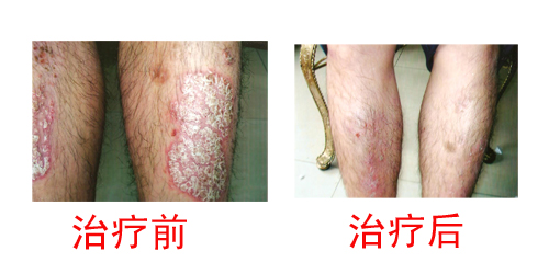 诱发牛皮癣的原因