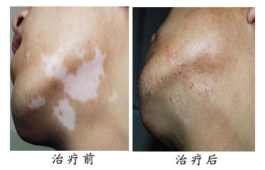 治疗白癜风的方法