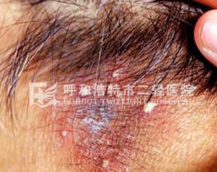 脱发性毛囊炎的症状和预防