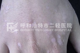 扁平疣可以治好吗