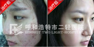 痤疮青春都的不同症状
