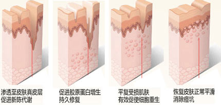 青春痘和痤疮区别