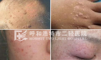偏方帮你治疗扁平