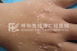 得了扁平疣的原因