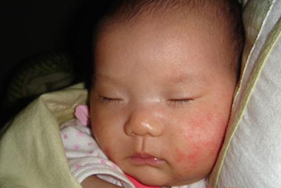 婴儿湿疹的表现